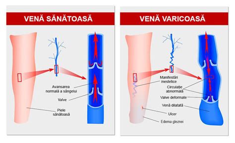 cum să restabiliți fluxul corect de sânge în venele picioarelor cu vene varicoase